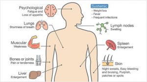 leukemia-symptoms-722x406