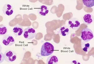 princ_rm_photo_of_cml_inside_blood