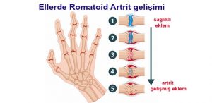 romatoid-artrit-el-eklem-sekil