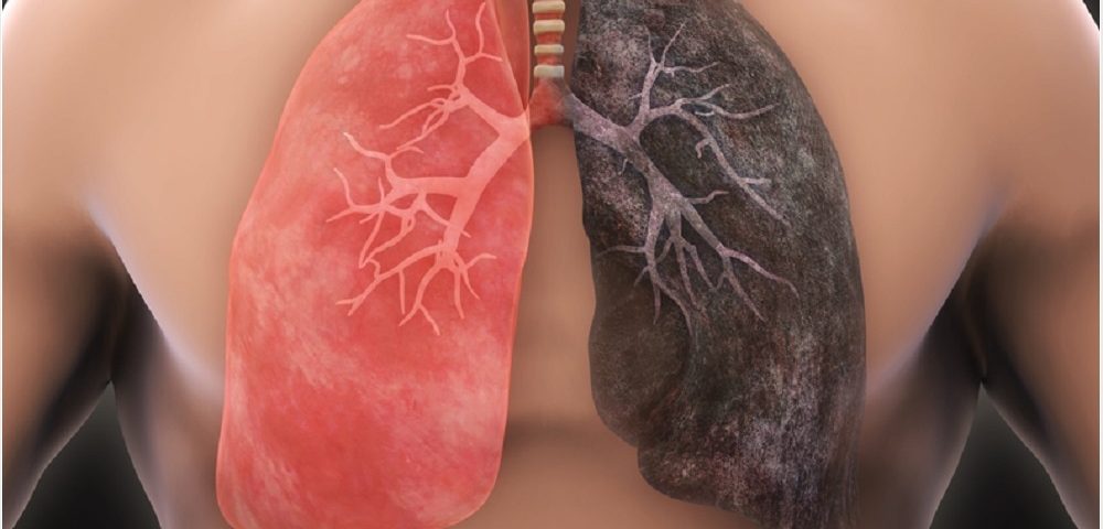 lung cancer