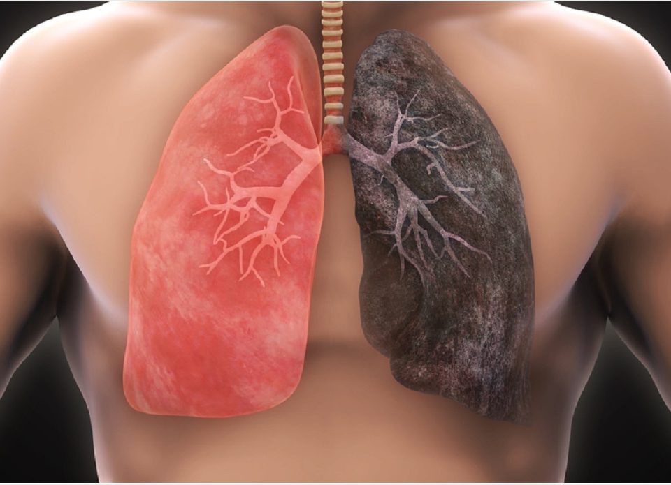 lung cancer