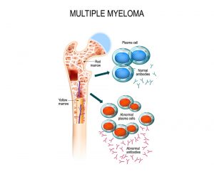 multiple-myeloma-1