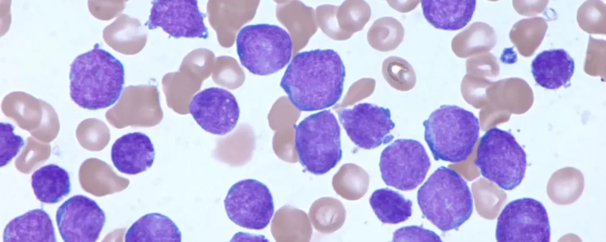 all-leukemia