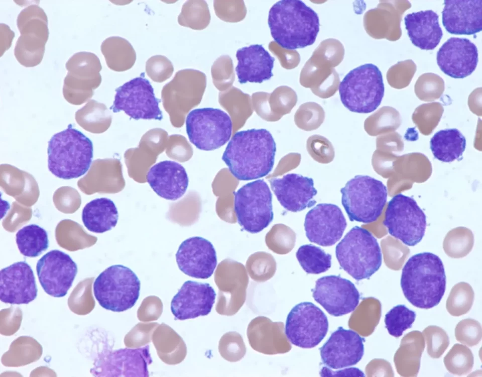all-leukemia